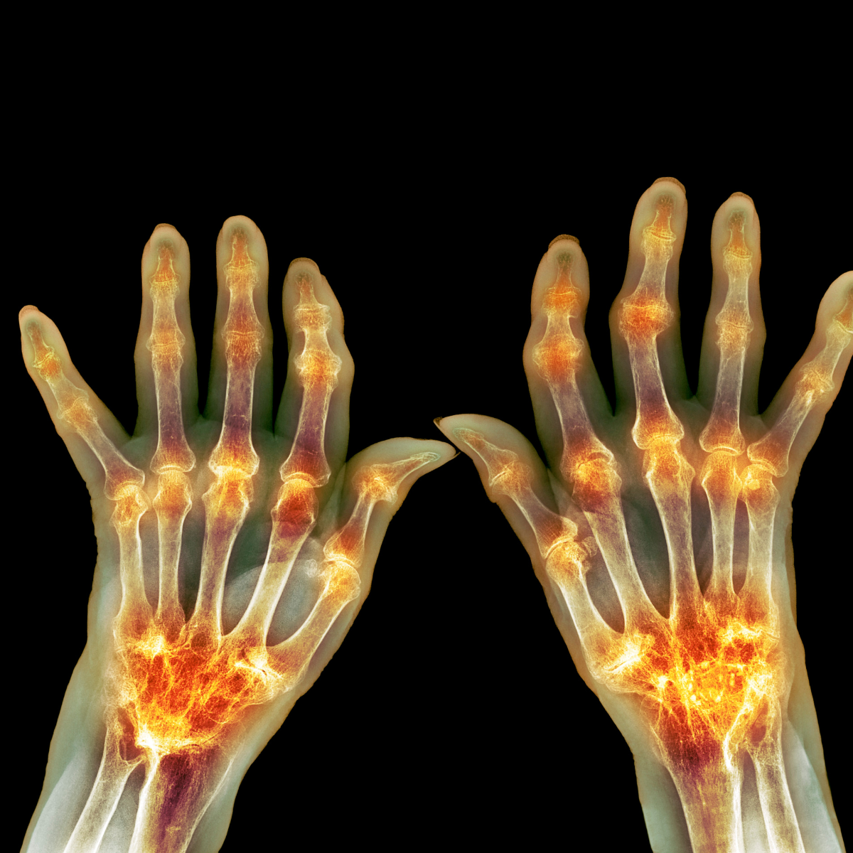 Rheumatoid Arthritis (RA)